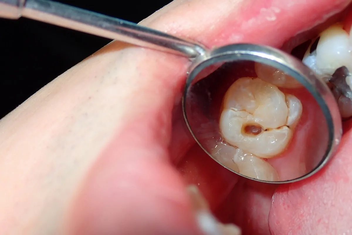 Why Do Teeth Crack? Common Causes to Know Stafford