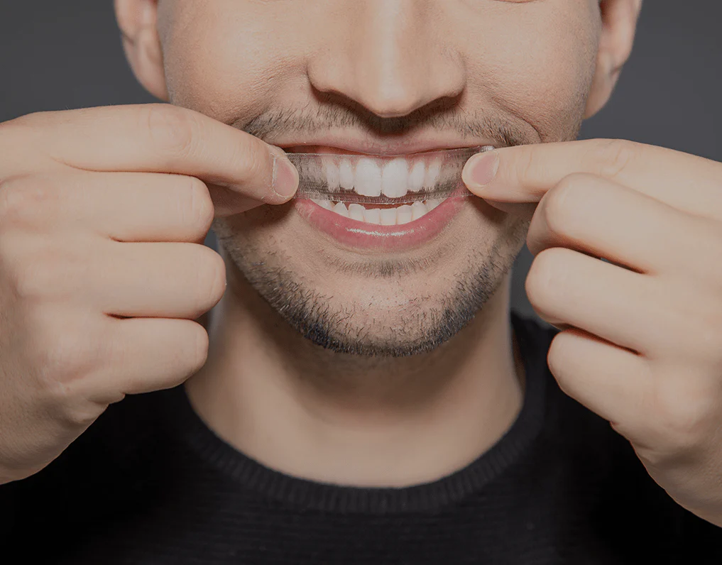 What to Consider Before Choosing a Teeth Whitening Option Stafford