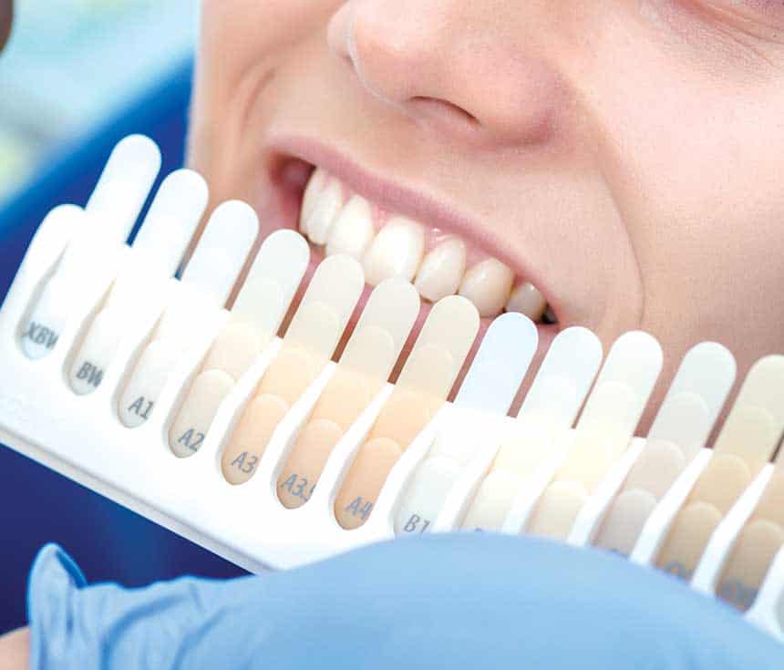Professional vs At-Home Whitening: What You Need to Know Stafford